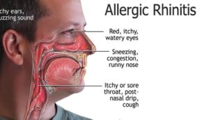 nasal congestion allergies